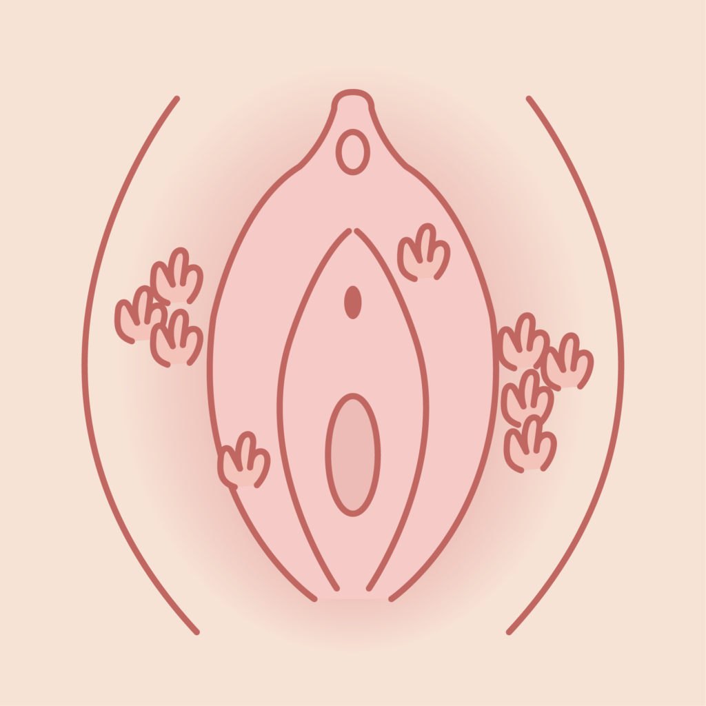 尖圭コンジローマ