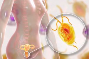女性がトリコモナス膣炎になったイメージ